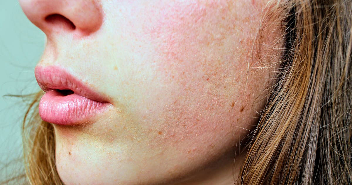 Rosacea